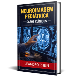 Este e-book apresenta uma revisão abrangente e altamente aplicada da neuroimagem pediátrica, com foco nas principais alterações estruturais e funcionais do sistema nervoso central em crianças. A obra explora, de forma clara e aprofundada, as malformações congênitas do encéfalo, erros inatos do metabolismo e doenças desmielinizantes adquiridas, sempre com ênfase nos achados por ressonância magnética.
Partindo do desenvolvimento embrionário normal do encéfalo — incluindo indução dorsal e ventral, migração neuronal e mielinização — o material constrói uma base sólida para compreensão das alterações patológicas. Ao longo dos capítulos, o leitor é guiado por uma organização didática que conecta fisiologia, embriologia e imagem, permitindo entender não apenas o que aparece na imagem, mas por que aparece.
O conteúdo aborda, com riqueza de detalhes e correlação clínica, condições como:
Malformações de Chiari (I, II, III e IV)
Cefaloceles e suas variações anatômicas
Agenesia do corpo caloso
Holoprosencefalia (alobar, semilobar e lobar)
Lissencefalia, polimicrogiria e heterotopias
Esquizencefalia e hemimegalencefalia
Complexo de Dandy-Walker, entre outras
Cada condição é apresentada com descrição anatômica, fisiopatológica e, principalmente, com interpretação dos achados de neuroimagem — transformando este material em um guia essencial para profissionais que desejam ir além do superficial.
Mais do que um compilado teórico, este e-book é uma ferramenta clínica: ele ensina a enxergar padrões, interpretar imagens com precisão e tomar decisões baseadas em evidência.
Se você trabalha com neurovisão, neurologia, radiologia, reabilitação ou desenvolvimento infantil, este material não é opcional — é base.